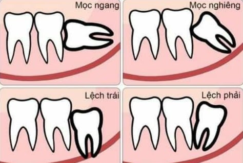 SAU KHI UỐNG XẠ CÓ NHỔ RĂNG ĐƯỢC KHÔNG?