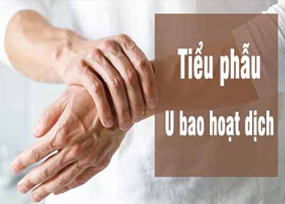 Tiểu phẫu u bao hoạt dịch